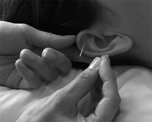 Ear-Acupuncture at Live Well